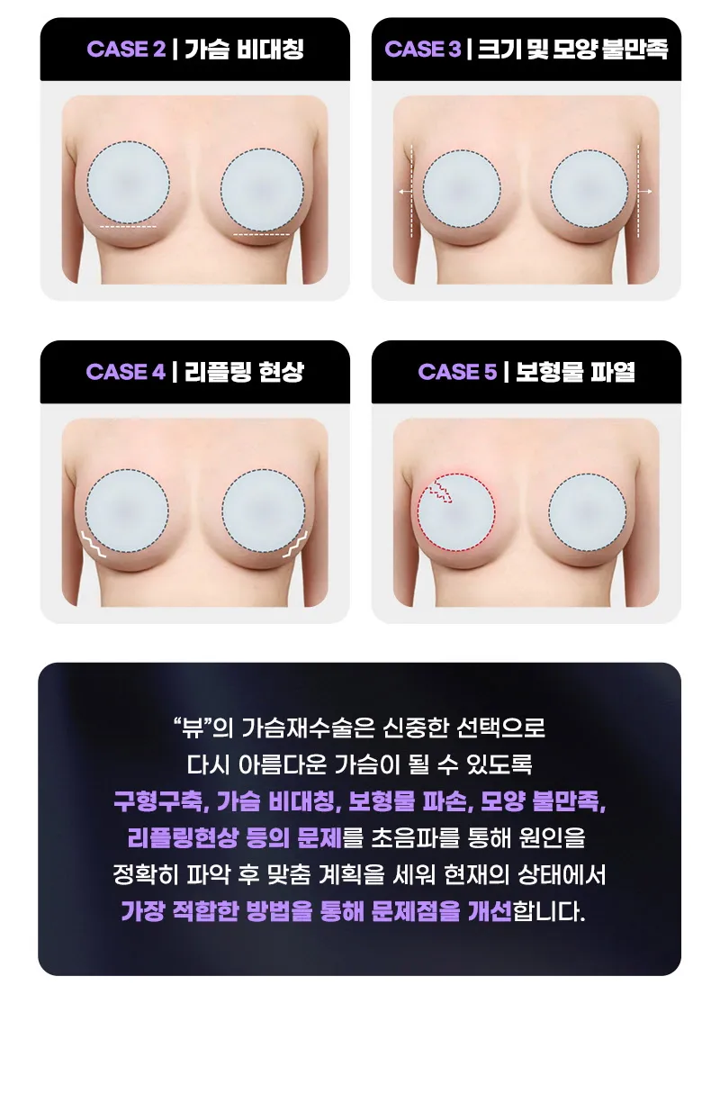 뷰성형외과 ❤뷰❤모티바 가슴 재수술 이벤트, 시술 상세 이미지
