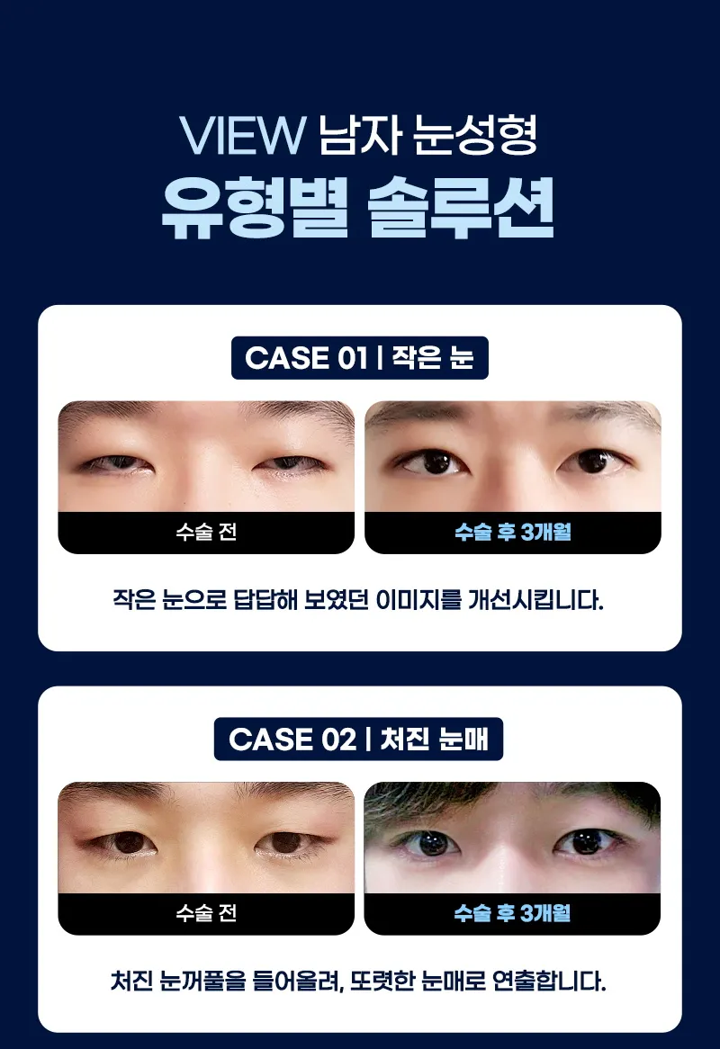 뷰성형외과 ❤️뷰❤️남자 눈성형 이벤트, 시술 상세 이미지