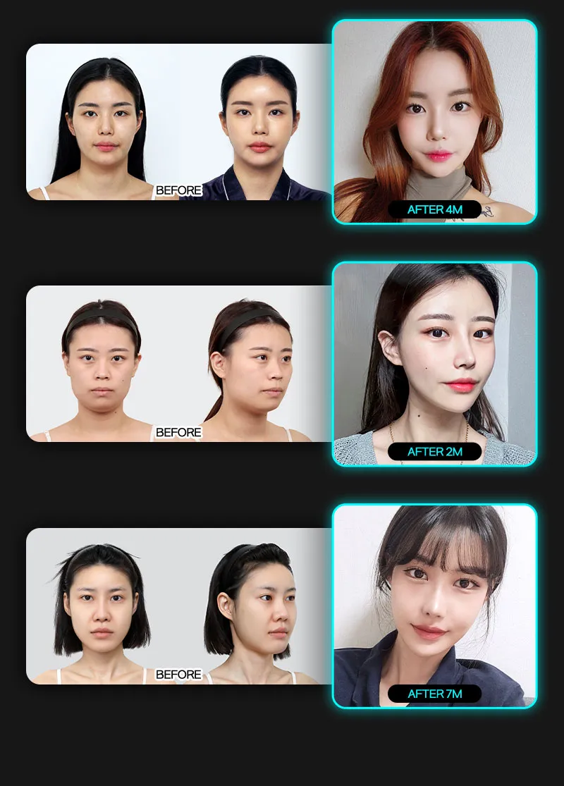 뷰성형외과 ❤️뷰❤️안면윤곽 이벤트, 시술 상세 이미지