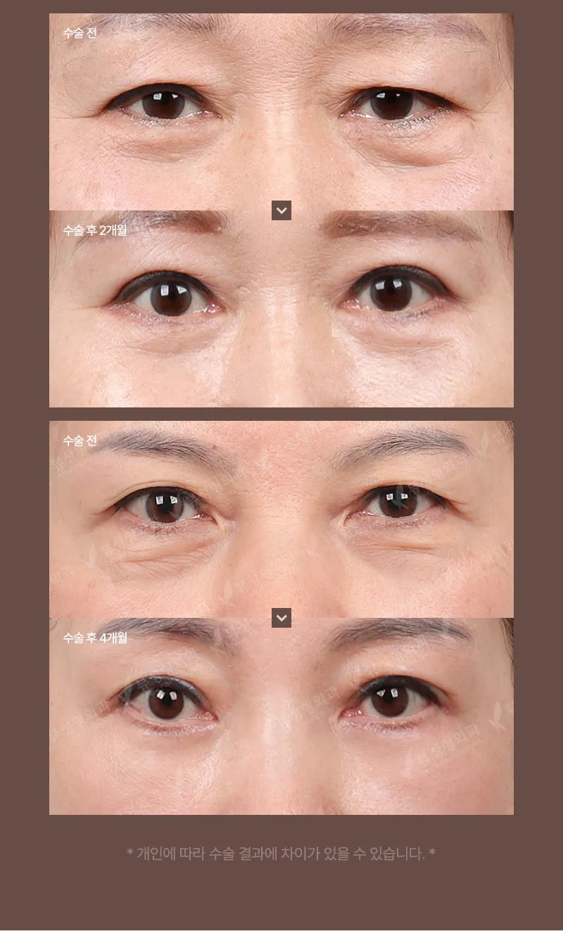 ❤️뷰❤️중년 눈성형
