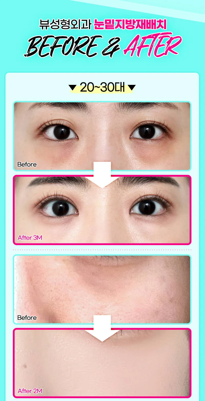 뷰성형외과 ❤️뷰❤️눈밑지방재배치 이벤트, 시술 상세 이미지
