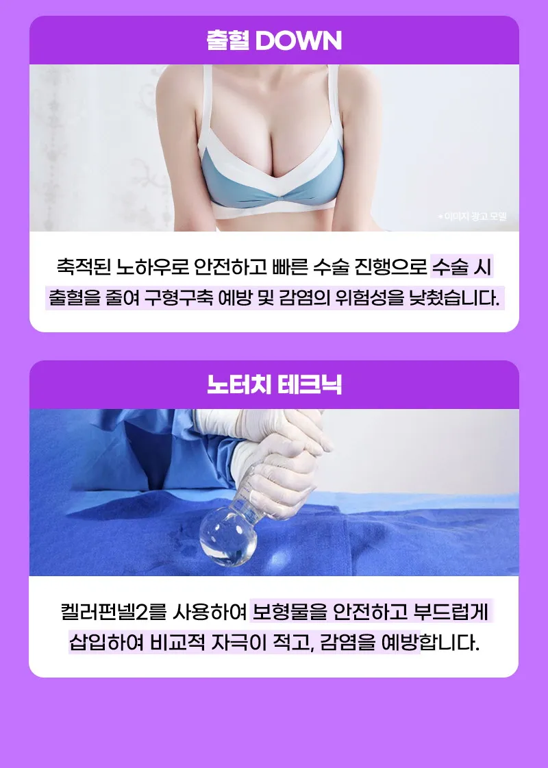 뷰성형외과 ❤뷰❤모티바 가슴 재수술 이벤트, 시술 상세 이미지