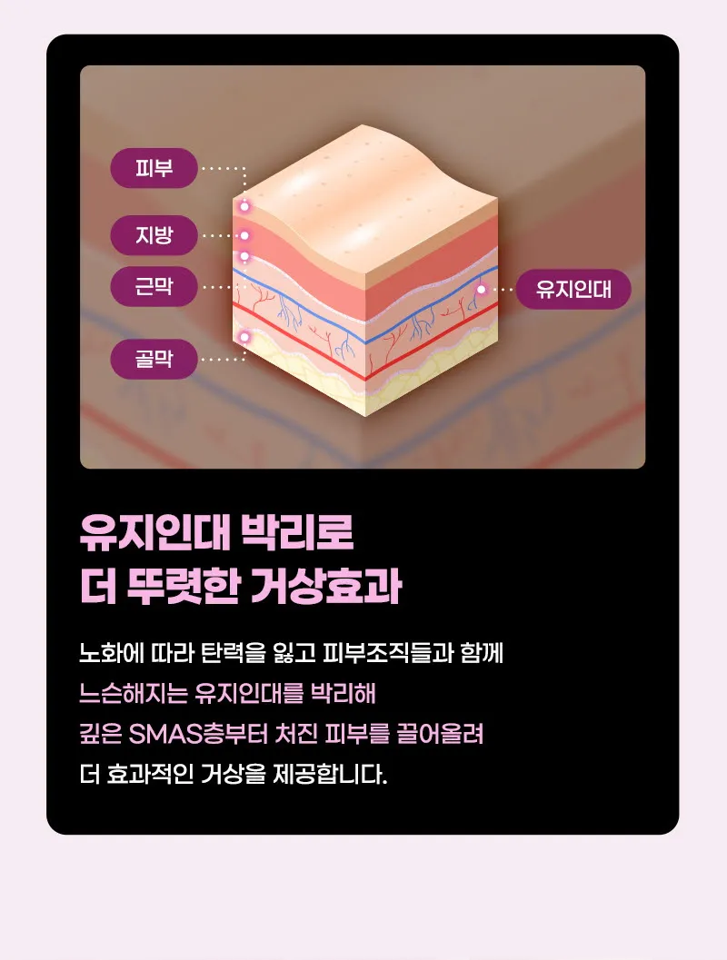 뷰성형외과 ❤뷰❤미니거상 이벤트, 시술 상세 이미지