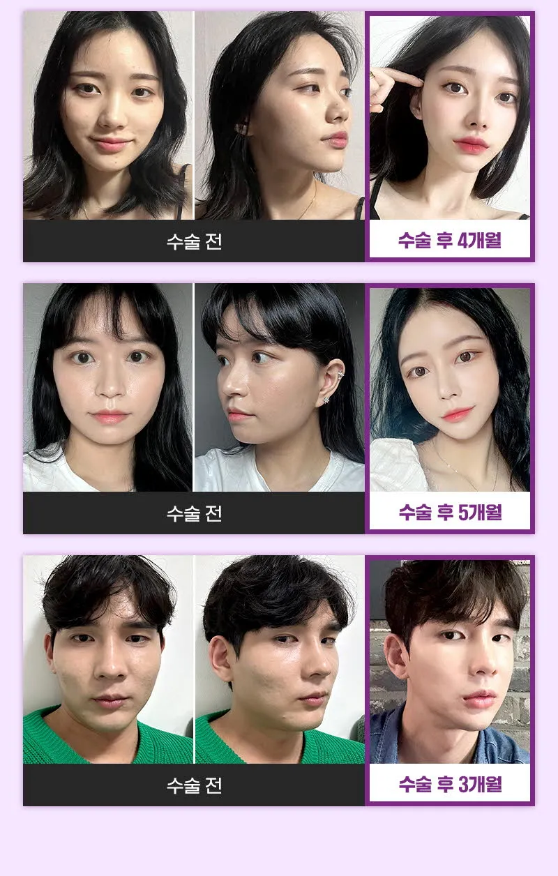 뷰성형외과 ❤️뷰❤️안면윤곽 재수술 이벤트, 시술 상세 이미지