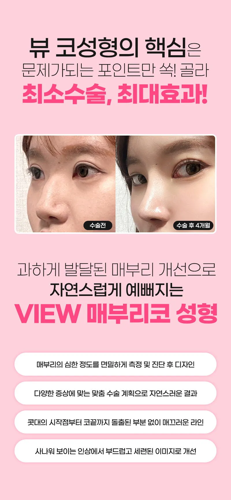뷰성형외과 ❤️뷰❤️매부리코성형 이벤트, 시술 상세 이미지