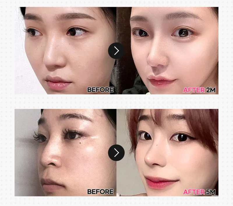 뷰성형외과 ❤️뷰❤️매부리코성형 이벤트, 시술 상세 이미지