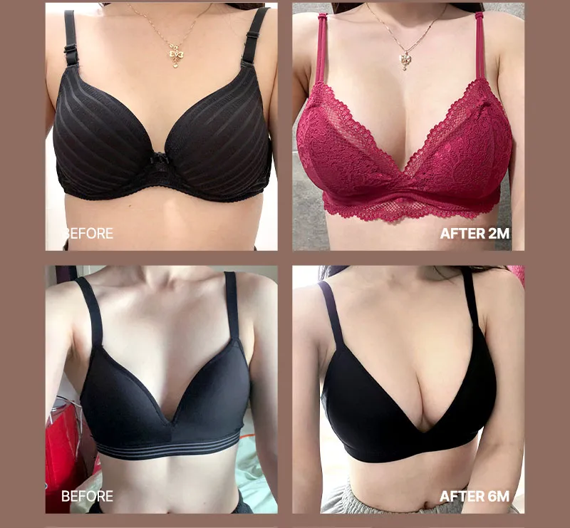 뷰성형외과 ❤뷰❤여의사 UIU 가슴성형 이벤트, 시술 상세 이미지