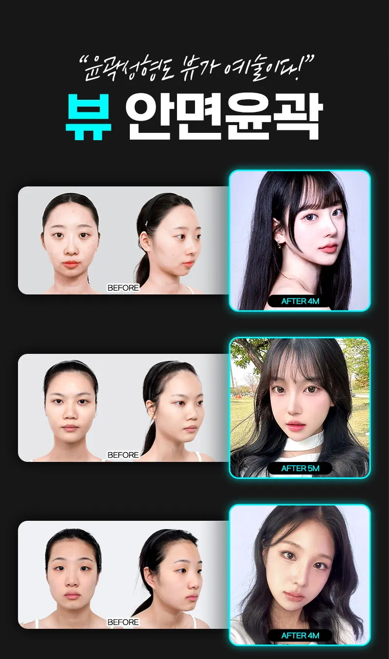 뷰성형외과 ❤️뷰❤️안면윤곽 이벤트, 시술 상세 이미지