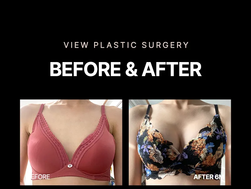 뷰성형외과 ❤뷰❤여의사 UIU 가슴성형 이벤트, 시술 상세 이미지