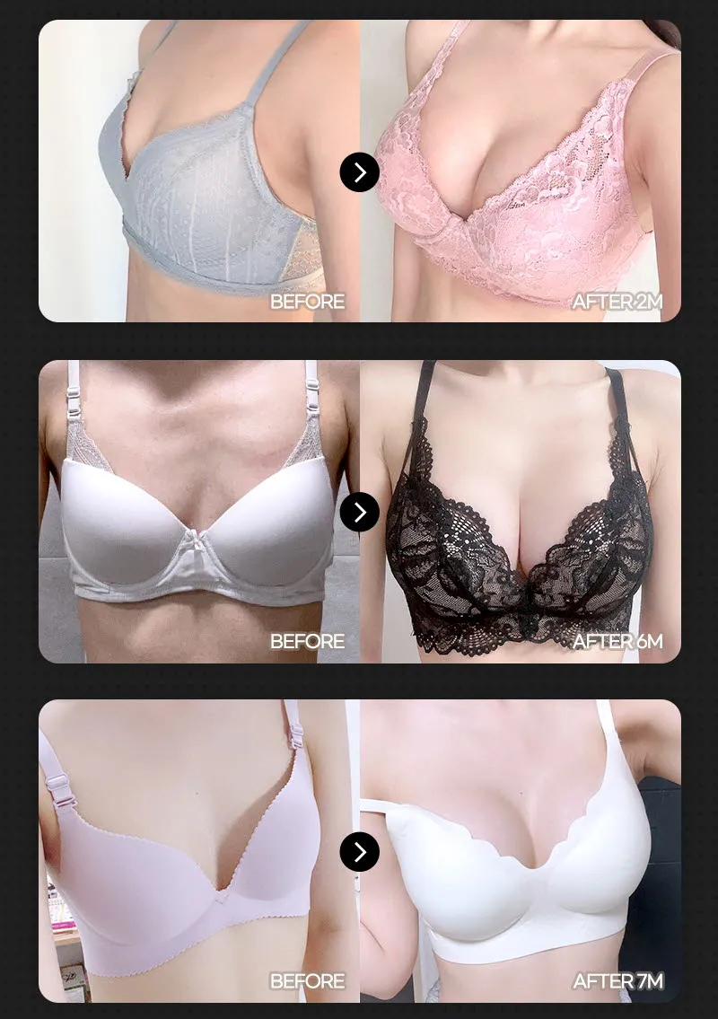 뷰성형외과 ❤️뷰❤️UIU 가슴성형 240 이벤트, 시술 상세 이미지