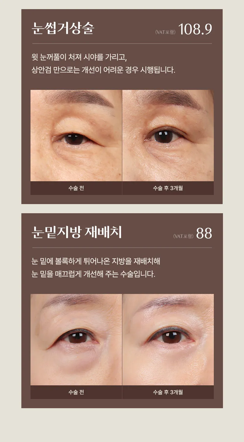 ❤️뷰❤️중년 눈성형