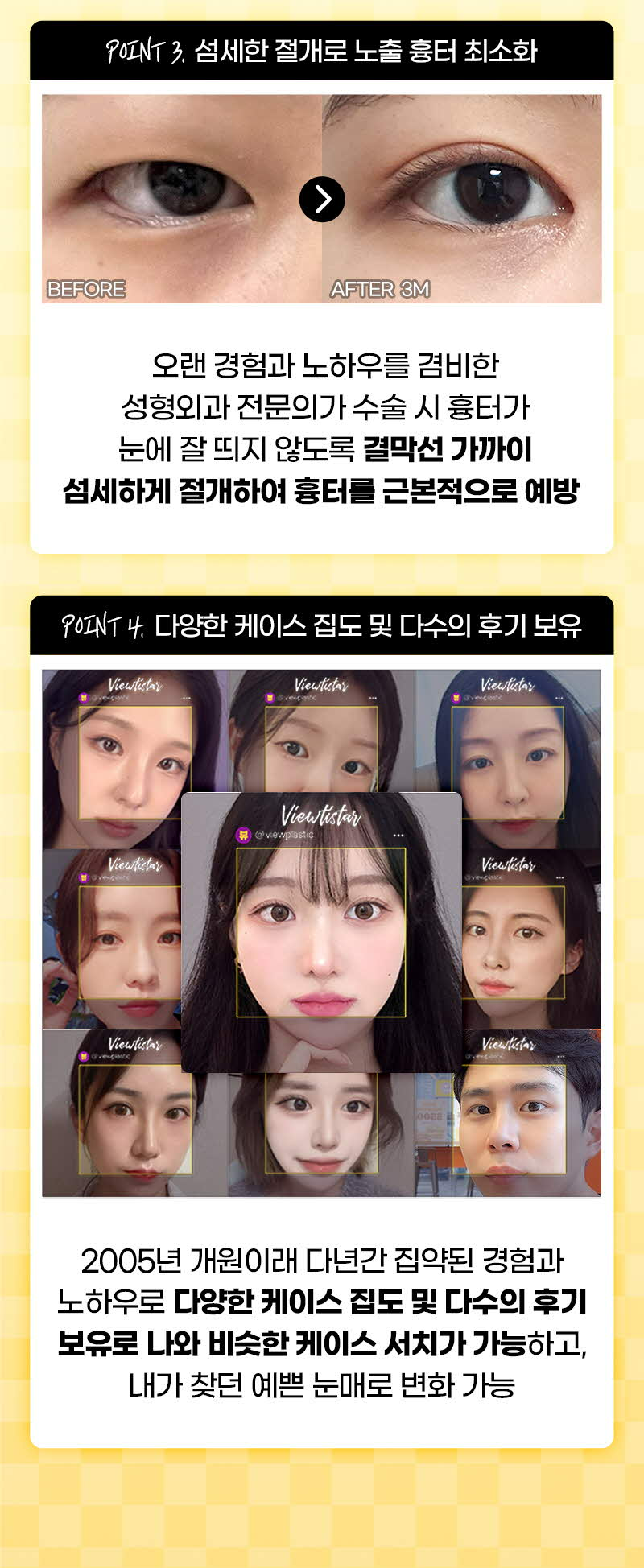뷰성형외과 ❤️뷰❤️오픈 트임  이벤트, 시술 상세 이미지