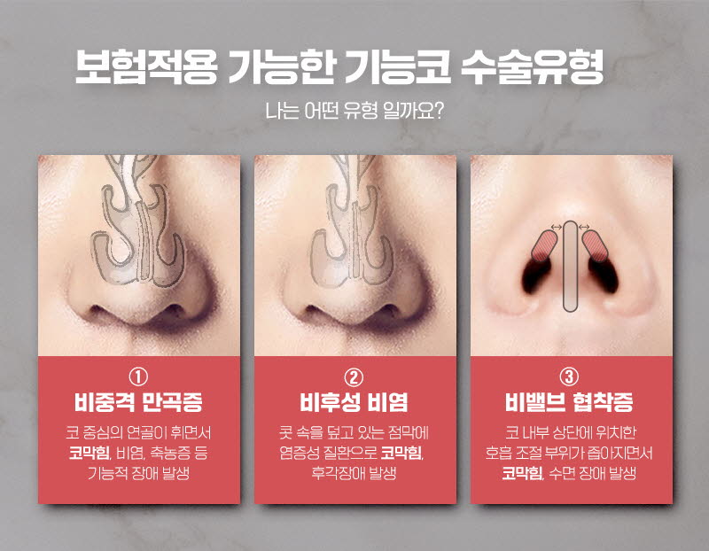 뷰성형외과 ❤️뷰❤️기능코성형 이벤트, 시술 상세 이미지