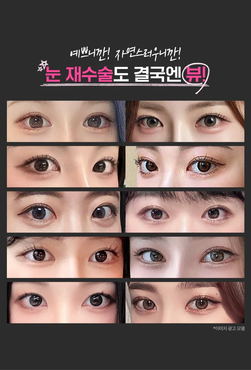 뷰성형외과 ❤️뷰❤️눈재수술 이벤트, 시술 상세 이미지
