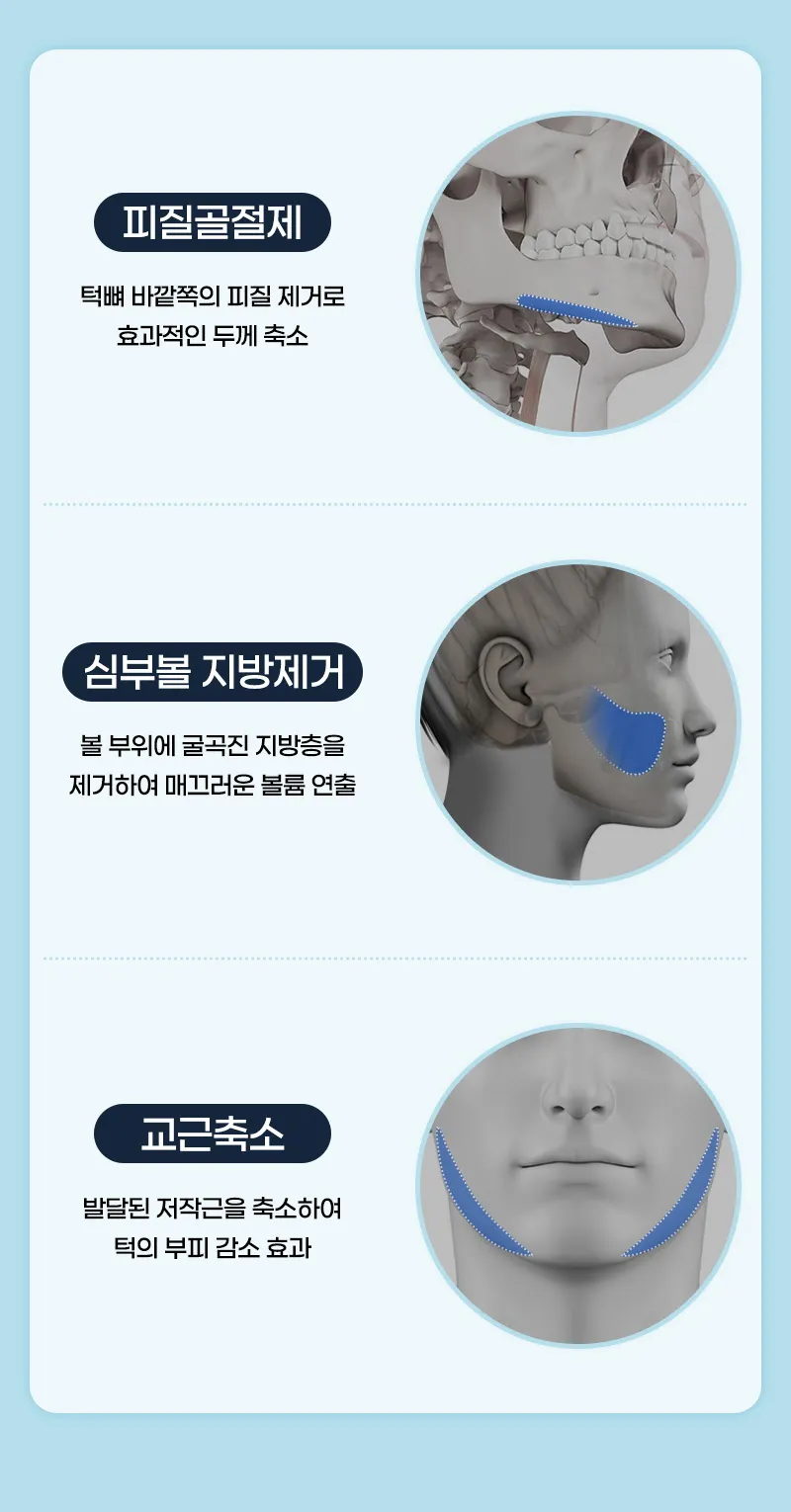 뷰성형외과 ❤️뷰❤️남자 안면윤곽 이벤트, 시술 상세 이미지