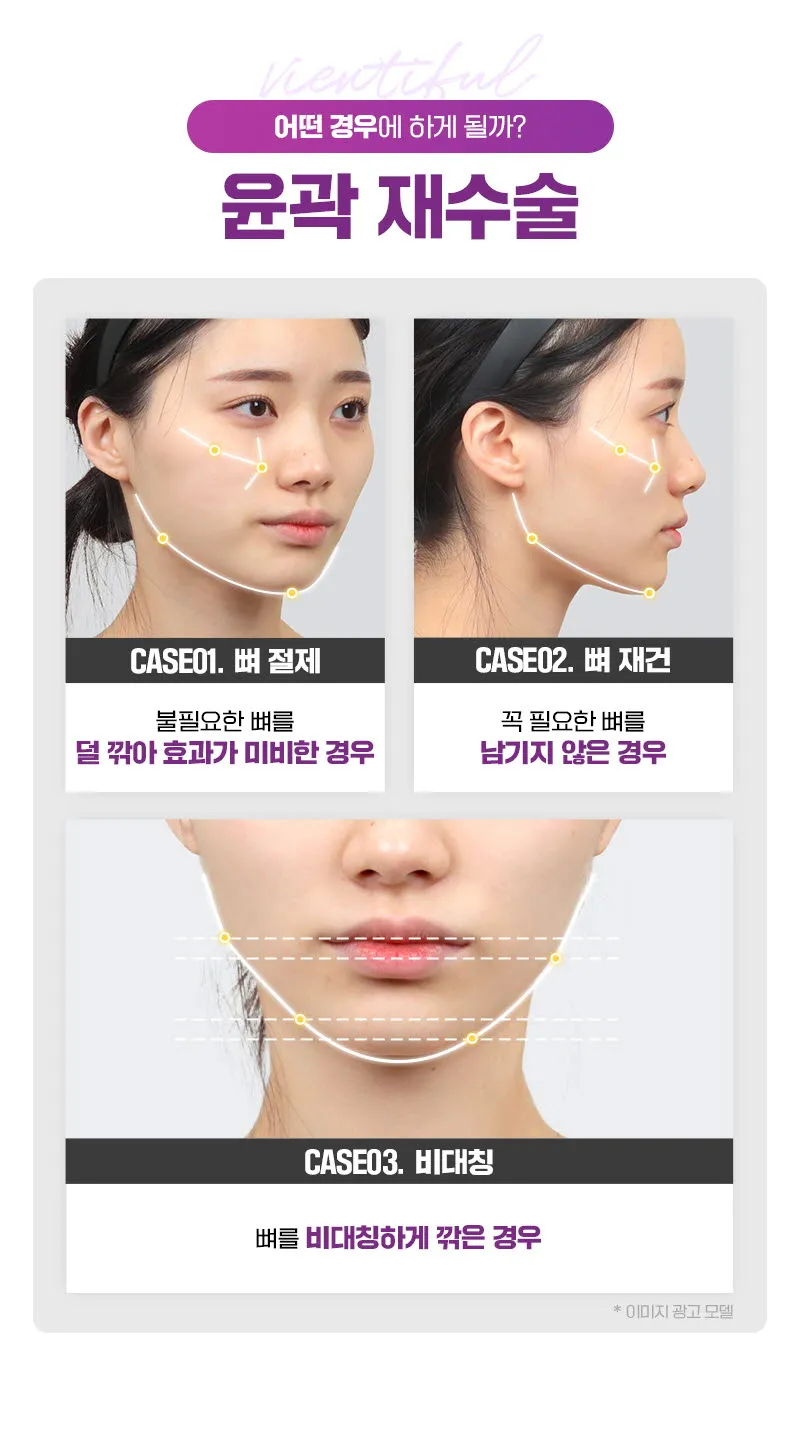뷰성형외과 ❤️뷰❤️안면윤곽 재수술 이벤트, 시술 상세 이미지
