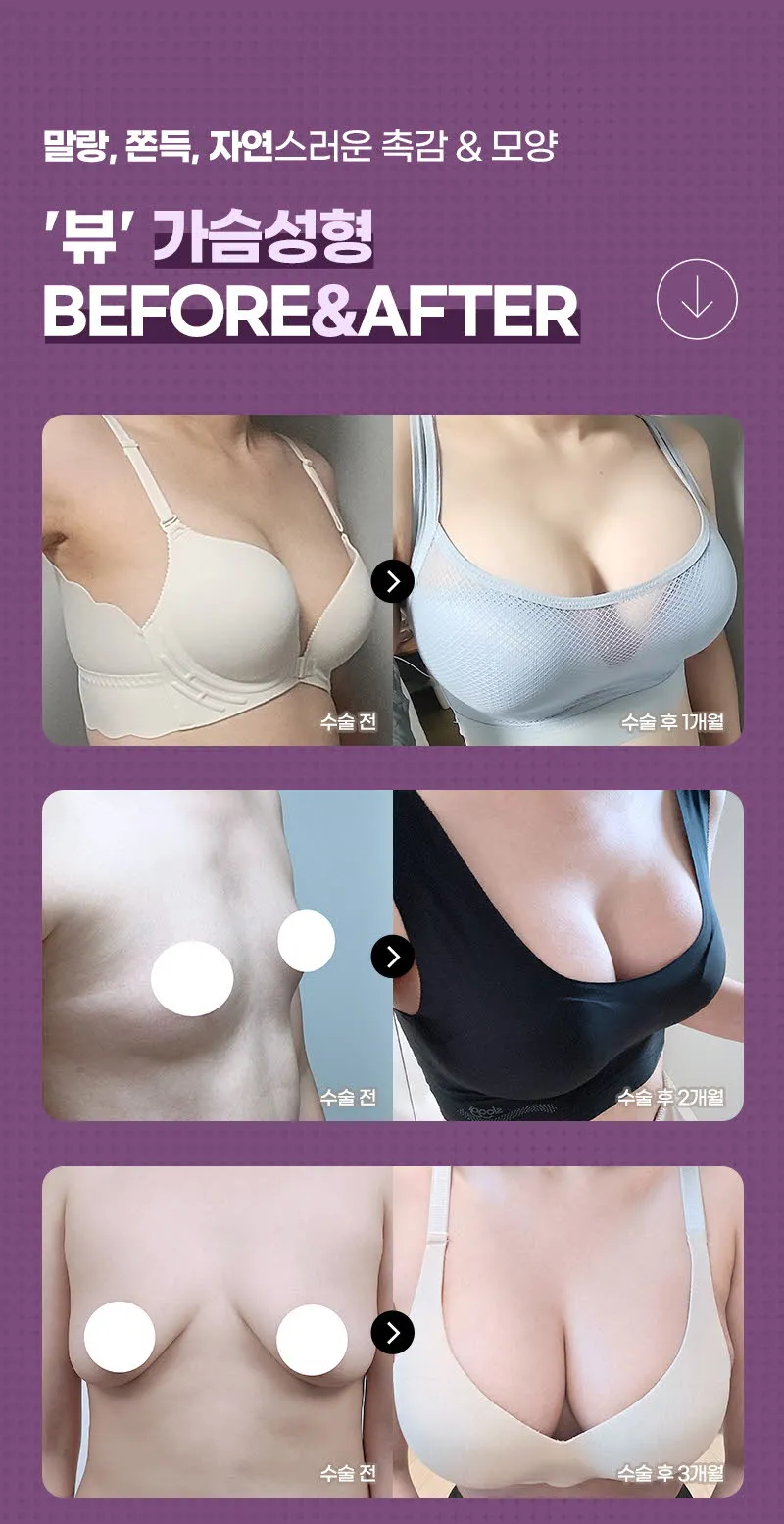 뷰성형외과 ❤️뷰❤️ 모티바 가슴성형 이벤트, 시술 상세 이미지