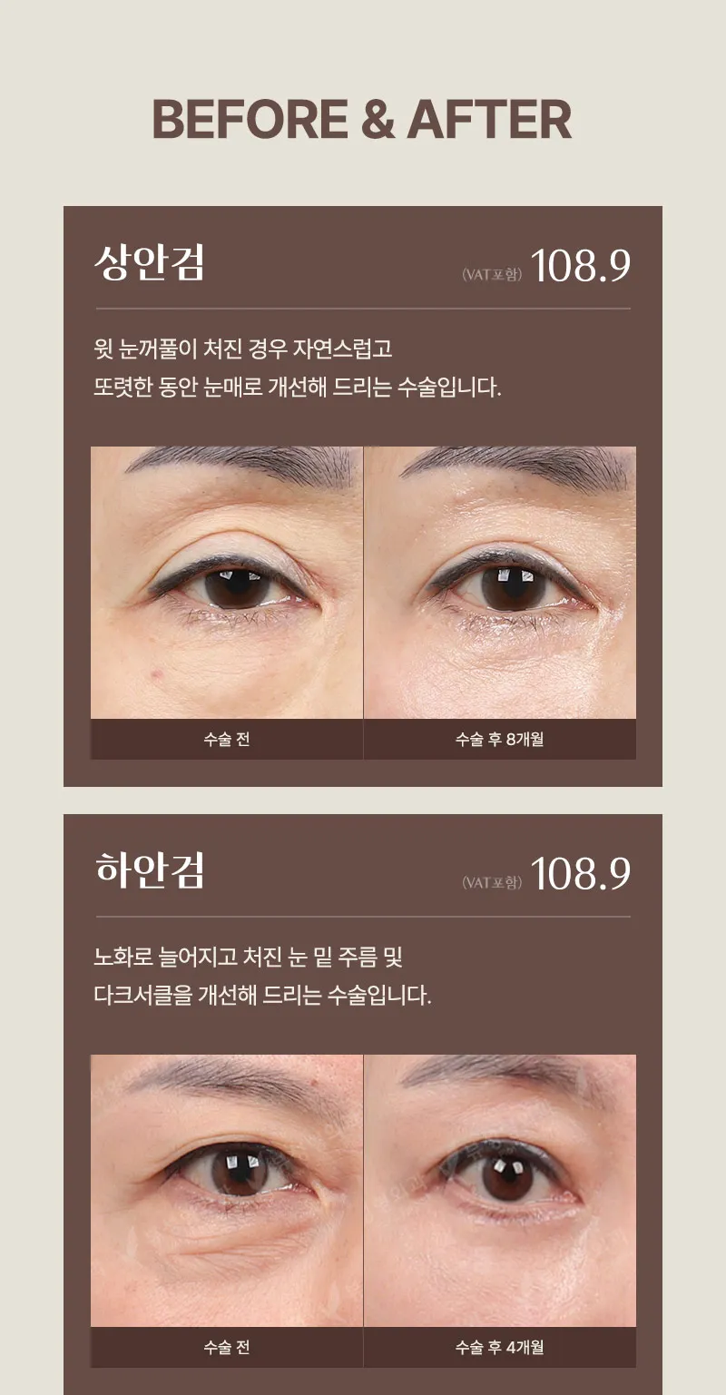 ❤️뷰❤️중년 눈성형