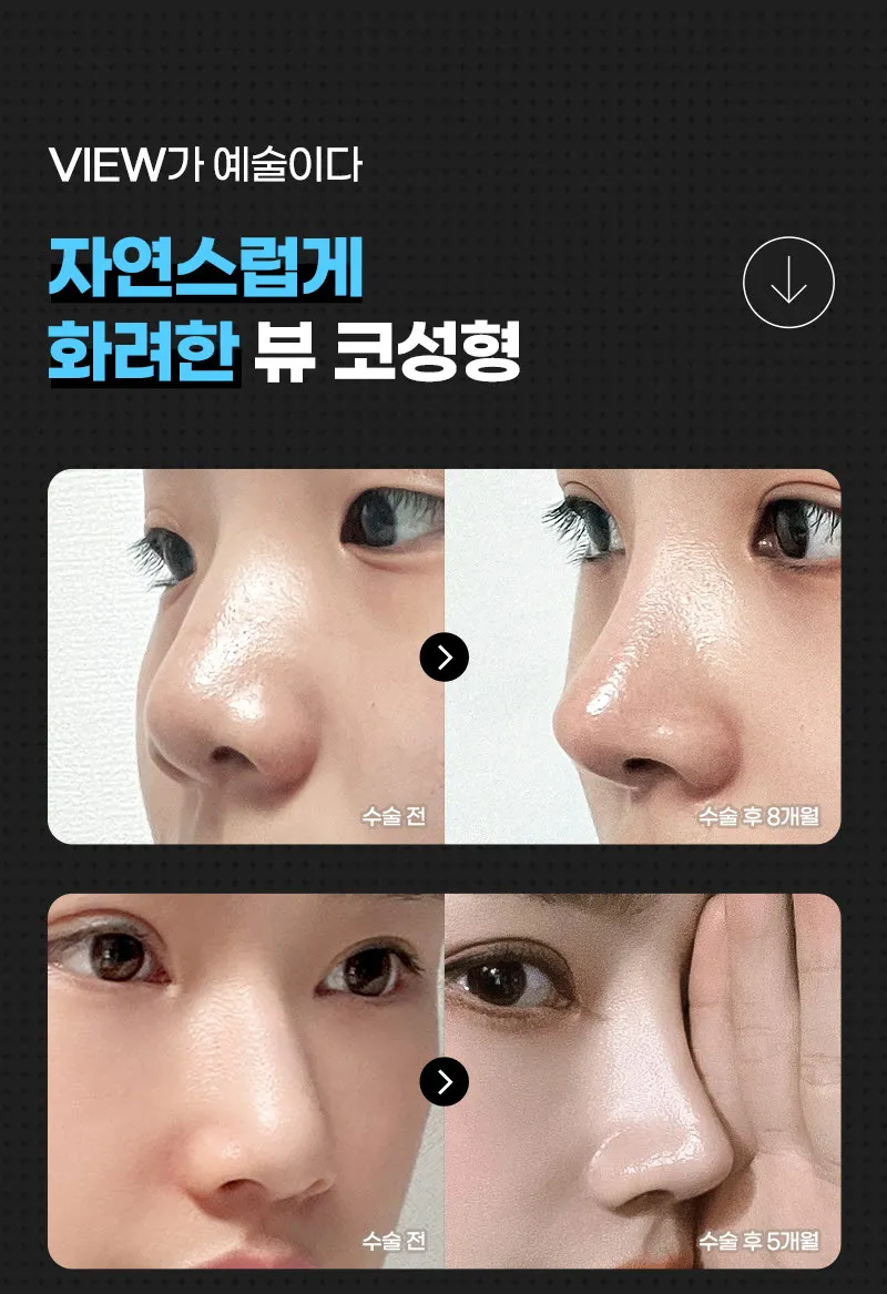뷰성형외과 ❤️뷰❤️코성형 이벤트, 시술 상세 이미지