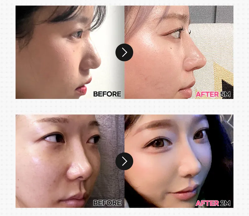 뷰성형외과 ❤️뷰❤️매부리코성형 이벤트, 시술 상세 이미지