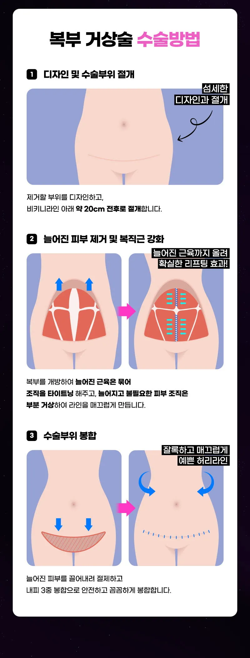 뷰성형외과 ❤뷰❤복부거상술 이벤트, 시술 상세 이미지