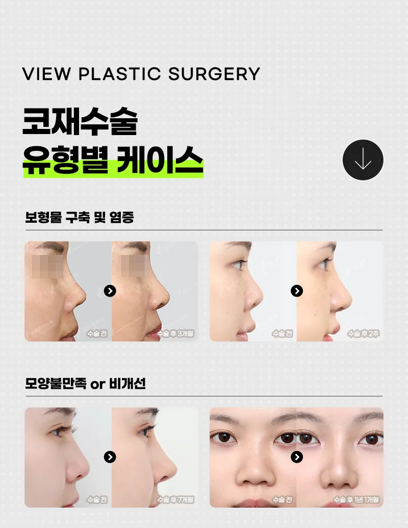 뷰성형외과 ❤️뷰❤️코재수술 이벤트, 시술 상세 이미지
