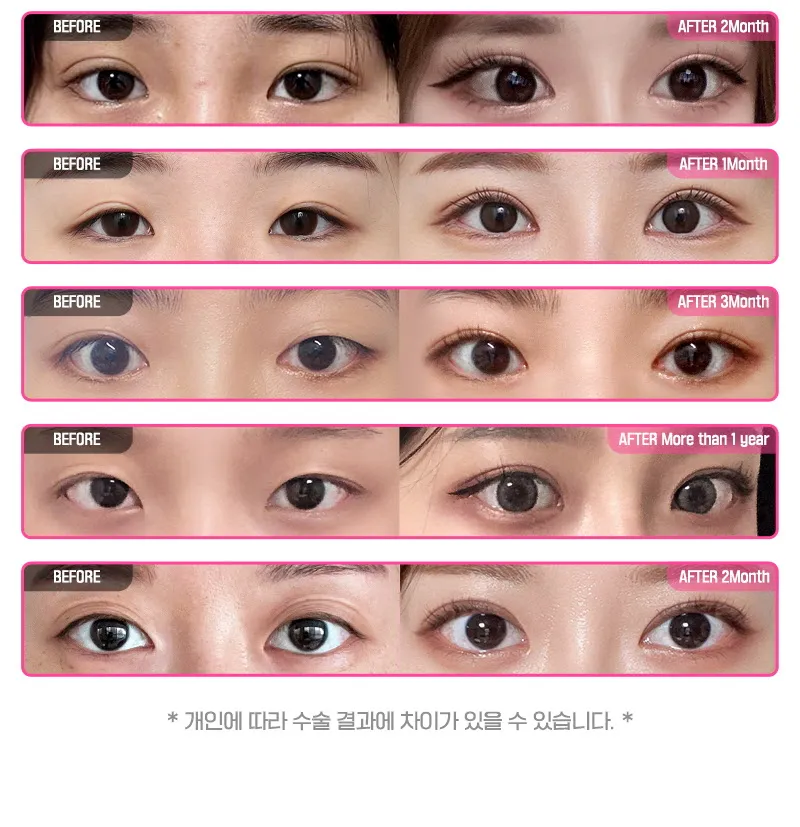 뷰성형외과 ❤️뷰❤️눈재수술 이벤트, 시술 상세 이미지
