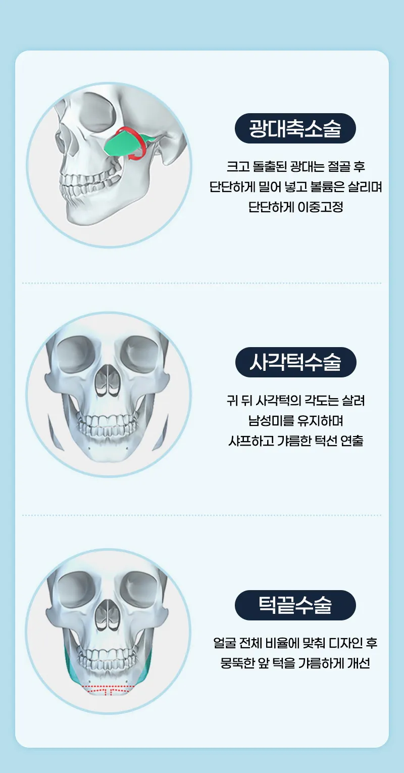 뷰성형외과 ❤️뷰❤️남자 안면윤곽 이벤트, 시술 상세 이미지