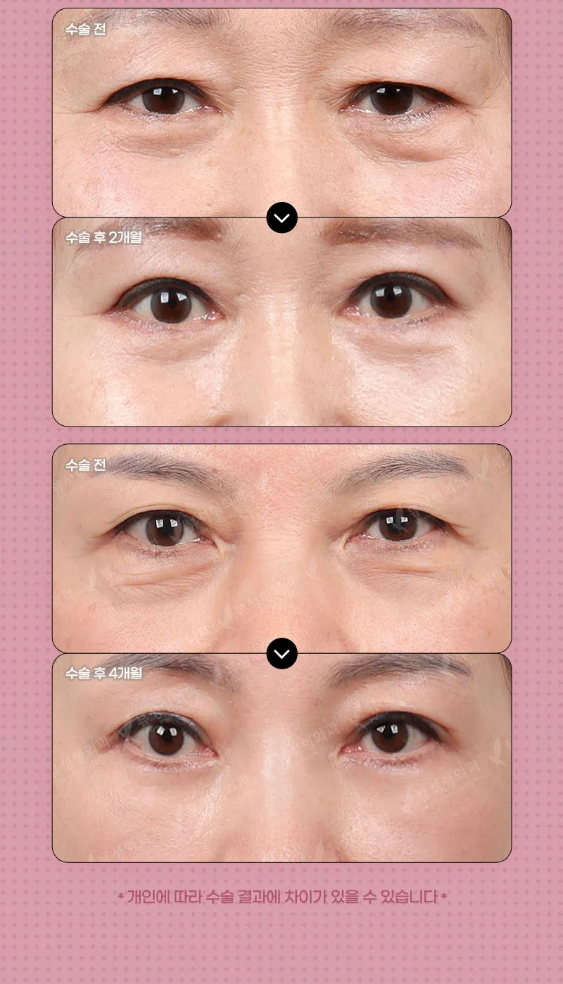 뷰성형외과 ❤️뷰❤️중년 눈성형 이벤트, 시술 상세 이미지