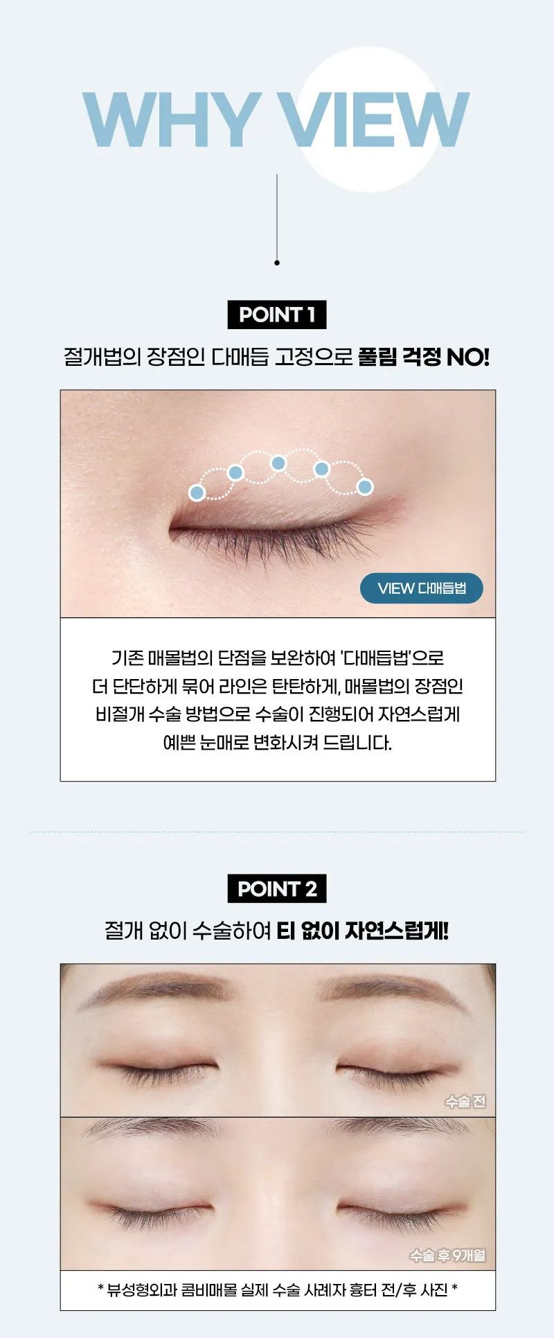 뷰성형외과 ❤️뷰❤️눈성형 이벤트, 시술 상세 이미지