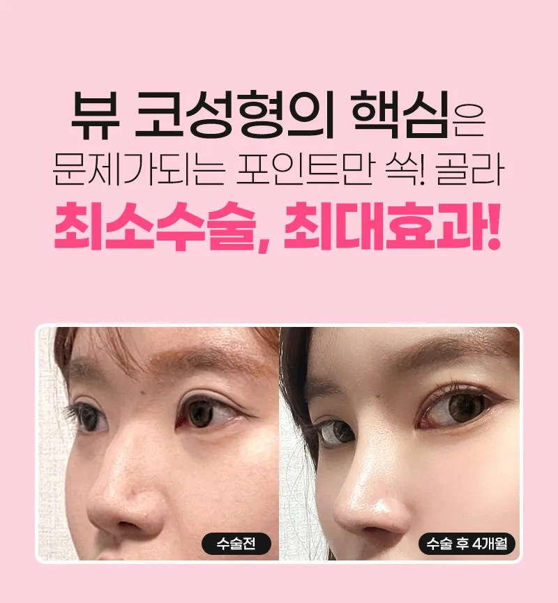 뷰성형외과 ❤️뷰❤️매부리코성형 이벤트, 시술 상세 이미지