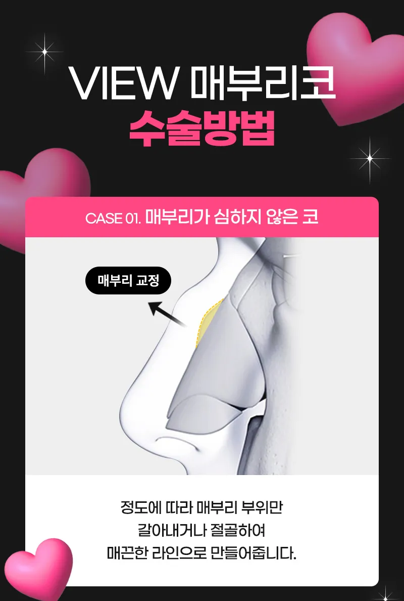 뷰성형외과 ❤️뷰❤️매부리코성형 이벤트, 시술 상세 이미지