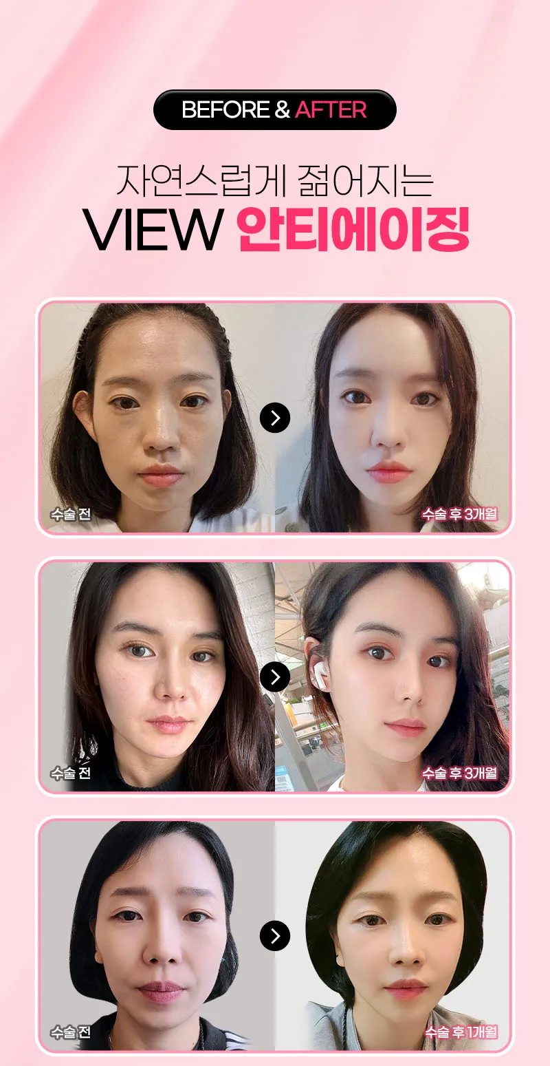 뷰성형외과 ❤뷰❤써마지 FLX 리프팅 이벤트, 시술 상세 이미지