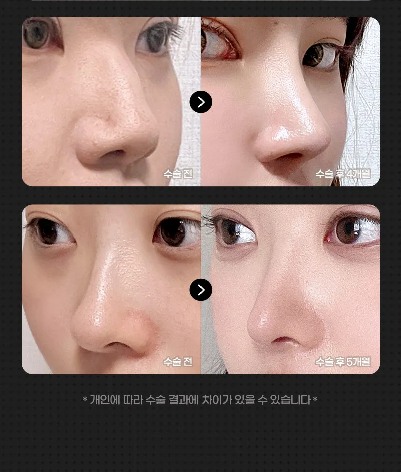 ❤️뷰❤️코성형