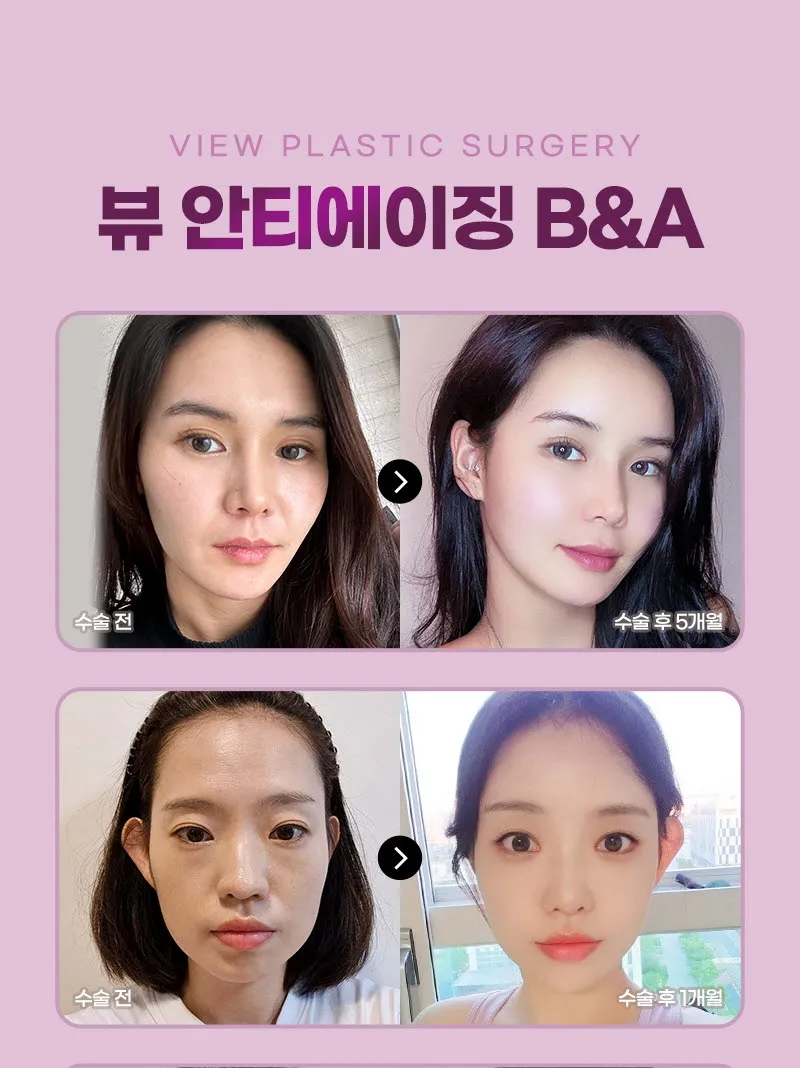 뷰성형외과 ❤뷰❤미니거상 이벤트, 시술 상세 이미지
