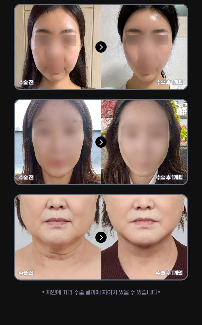 뷰성형외과 ❤뷰❤엘라스티꿈 실리프팅 이벤트, 시술 상세 이미지