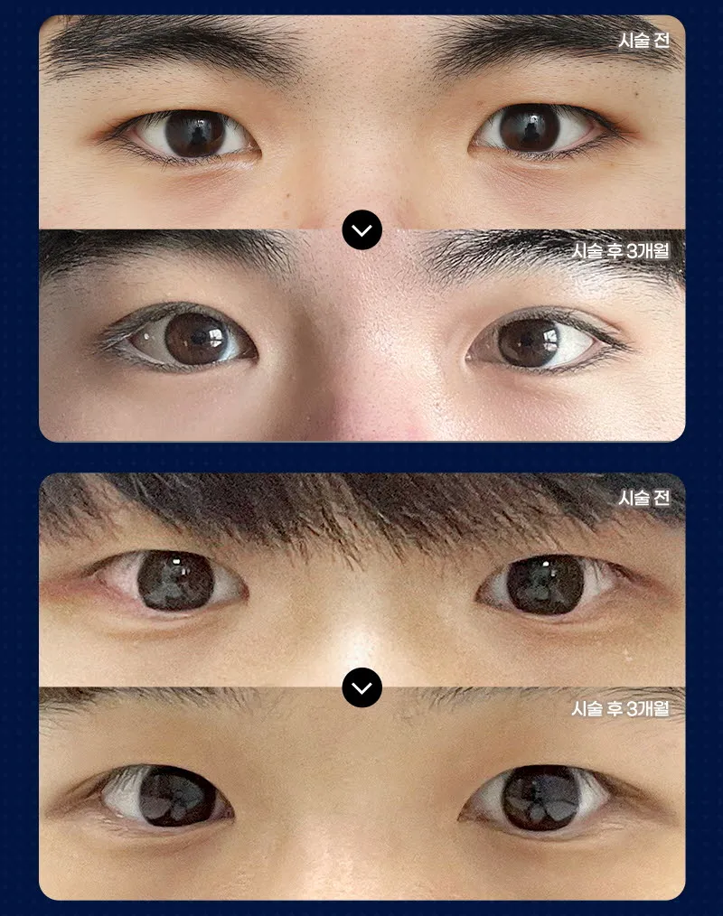 뷰성형외과 ❤️뷰❤️남자 눈성형 이벤트, 시술 상세 이미지