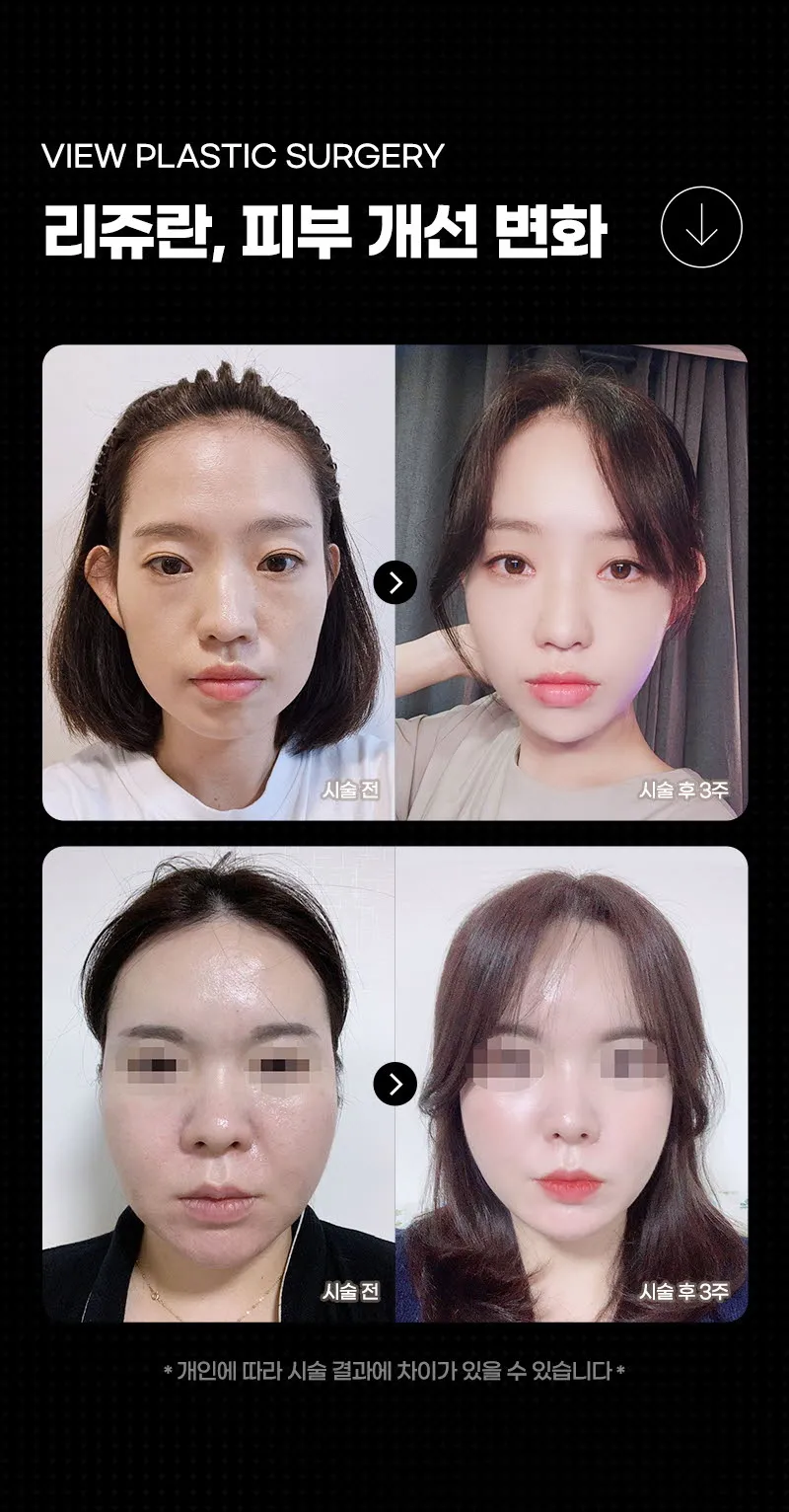 뷰성형외과 ❤️뷰❤️리쥬란힐러 4cc 이벤트, 시술 상세 이미지