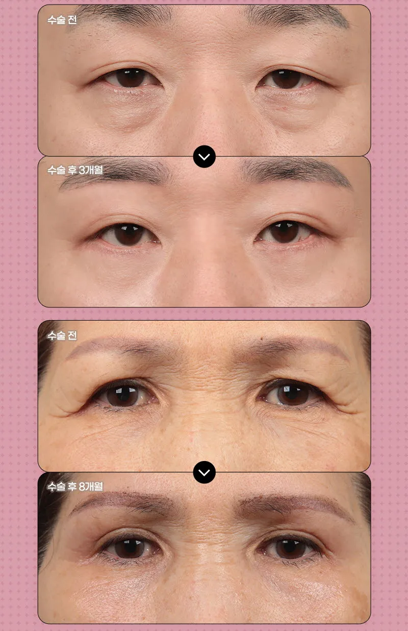 뷰성형외과 ❤️뷰❤️중년 눈성형 이벤트, 시술 상세 이미지