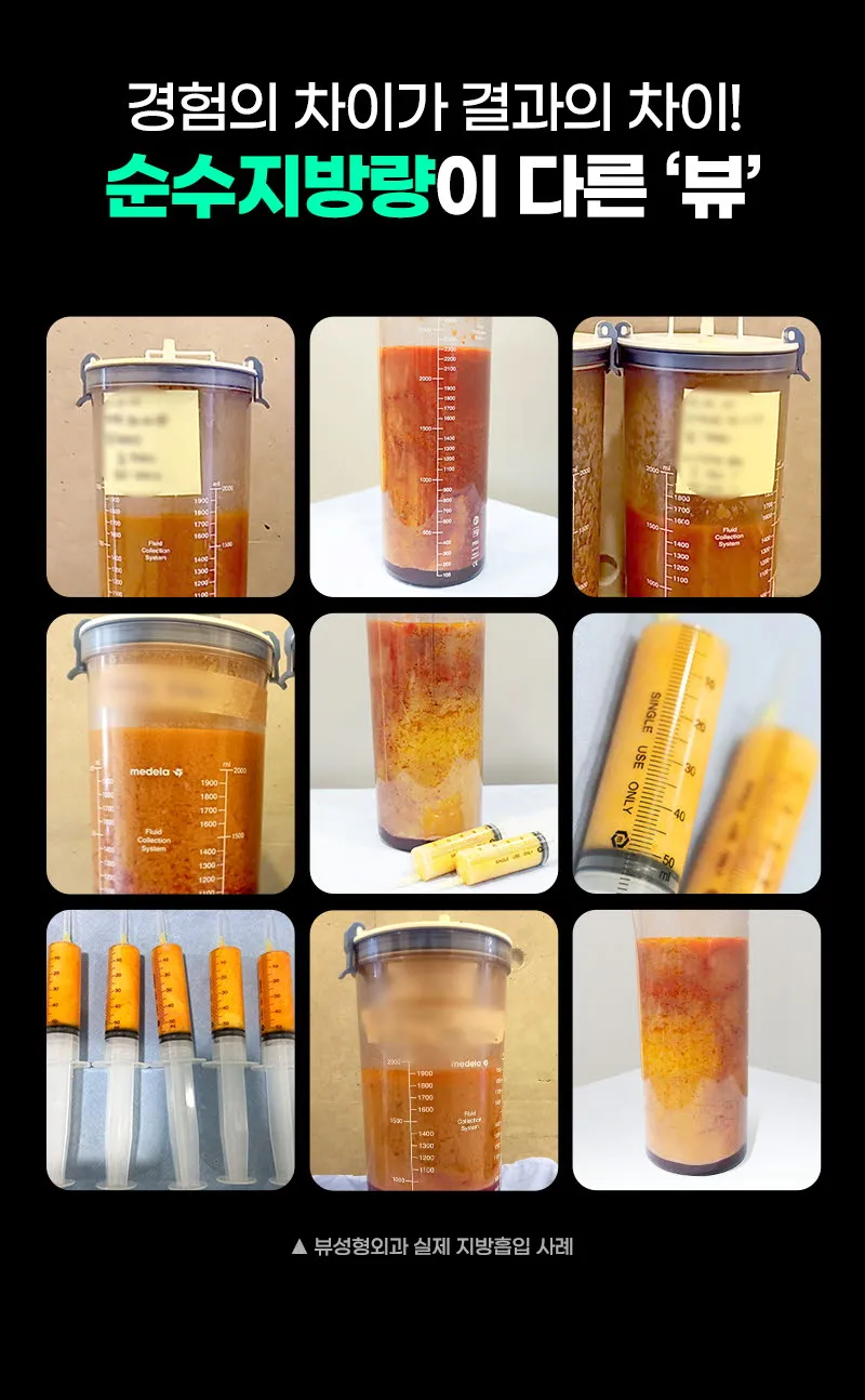 뷰성형외과 ❤️뷰❤️대용량 지방흡입 이벤트, 시술 상세 이미지