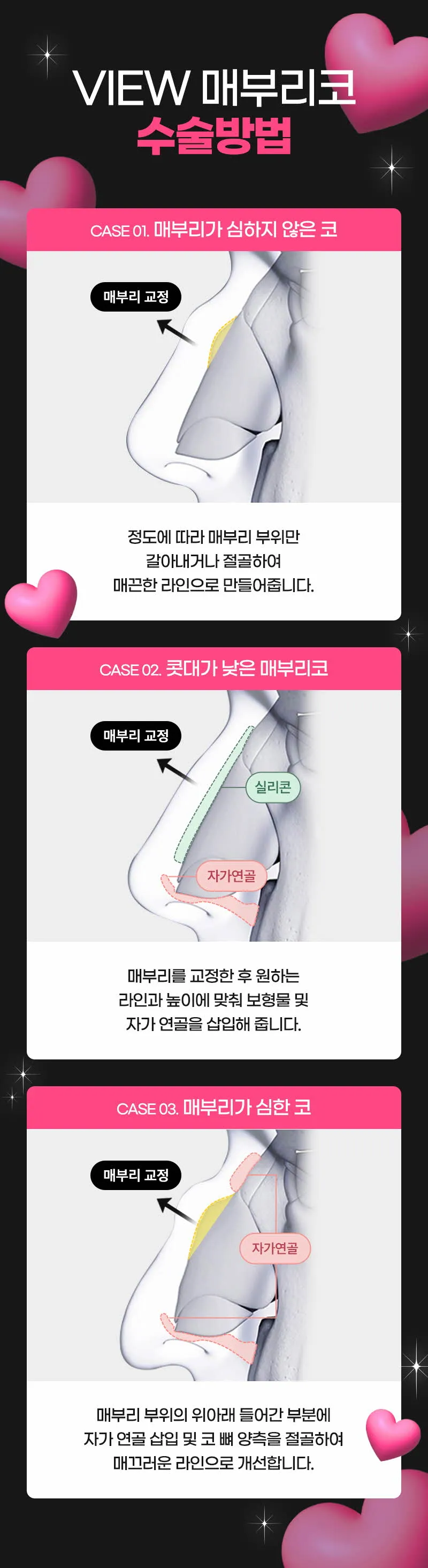 뷰성형외과 ❤️뷰❤️매부리코성형 이벤트, 시술 상세 이미지