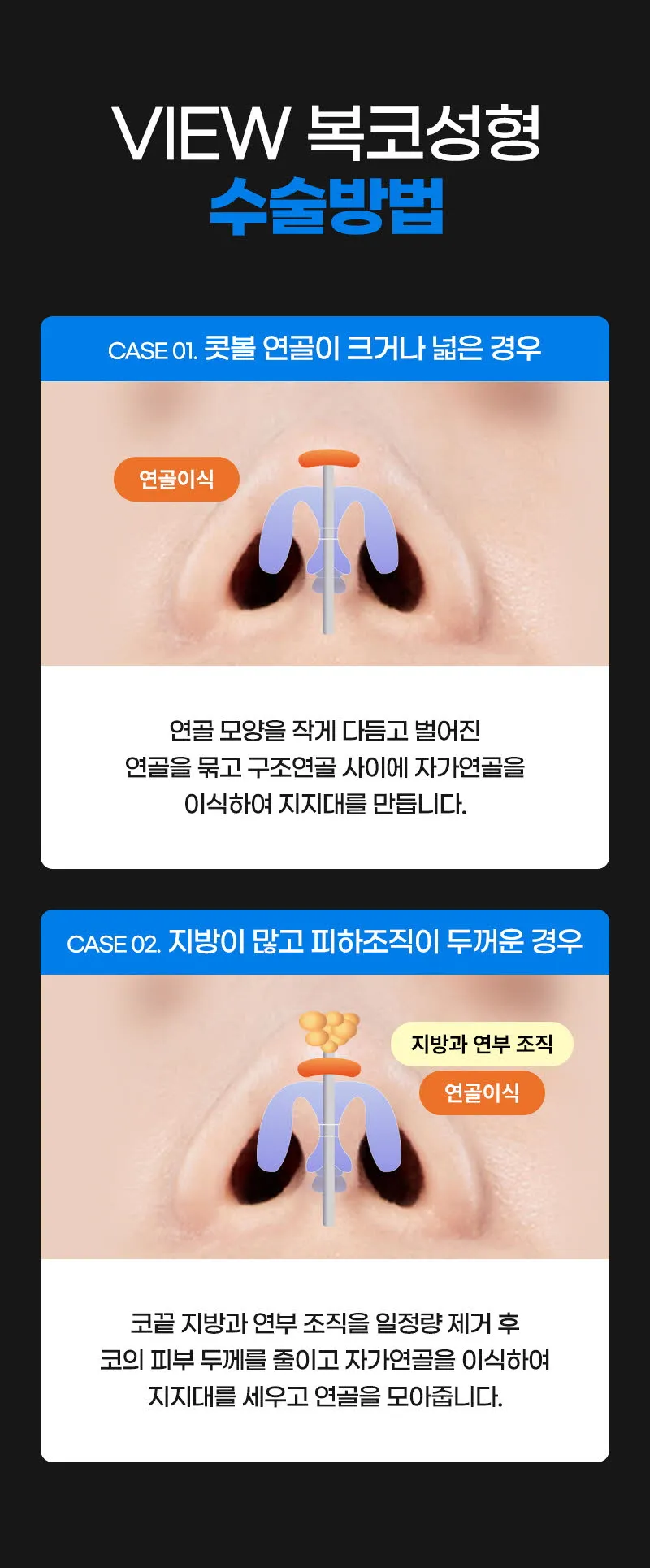 뷰성형외과 ❤️뷰❤️복코성형 이벤트, 시술 상세 이미지