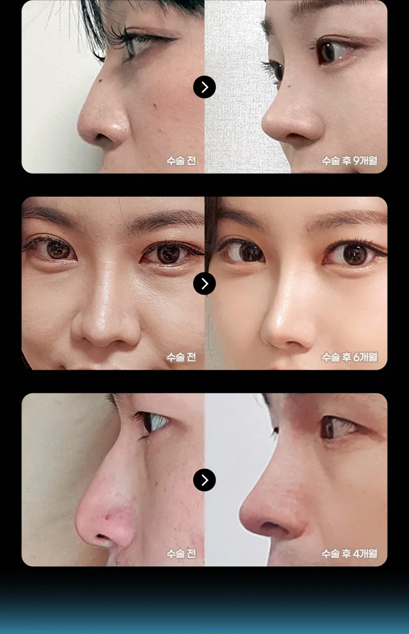 ❤️뷰❤️코성형