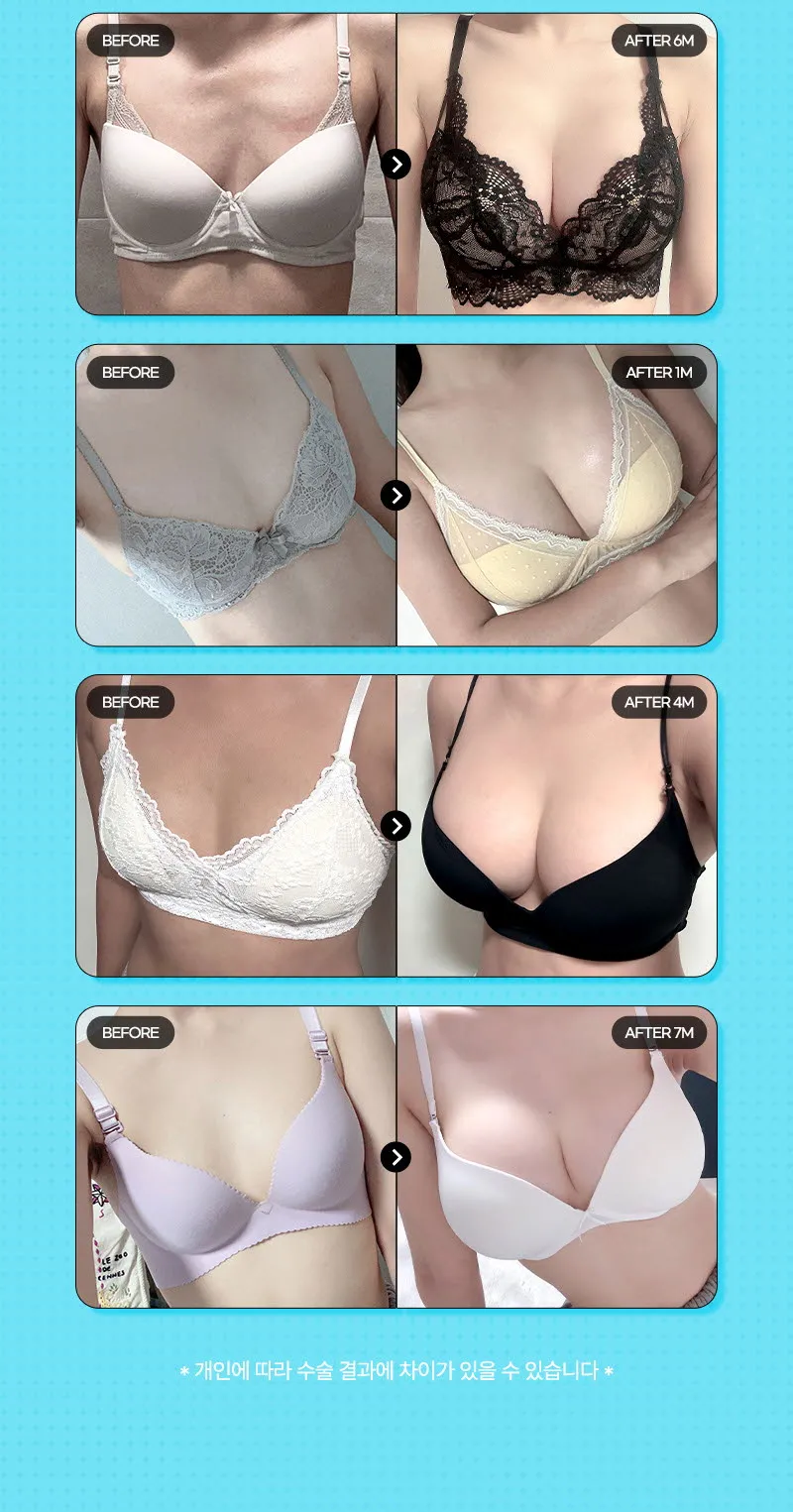 뷰성형외과 ❤️뷰❤️세빈 가슴성형 이벤트, 시술 상세 이미지