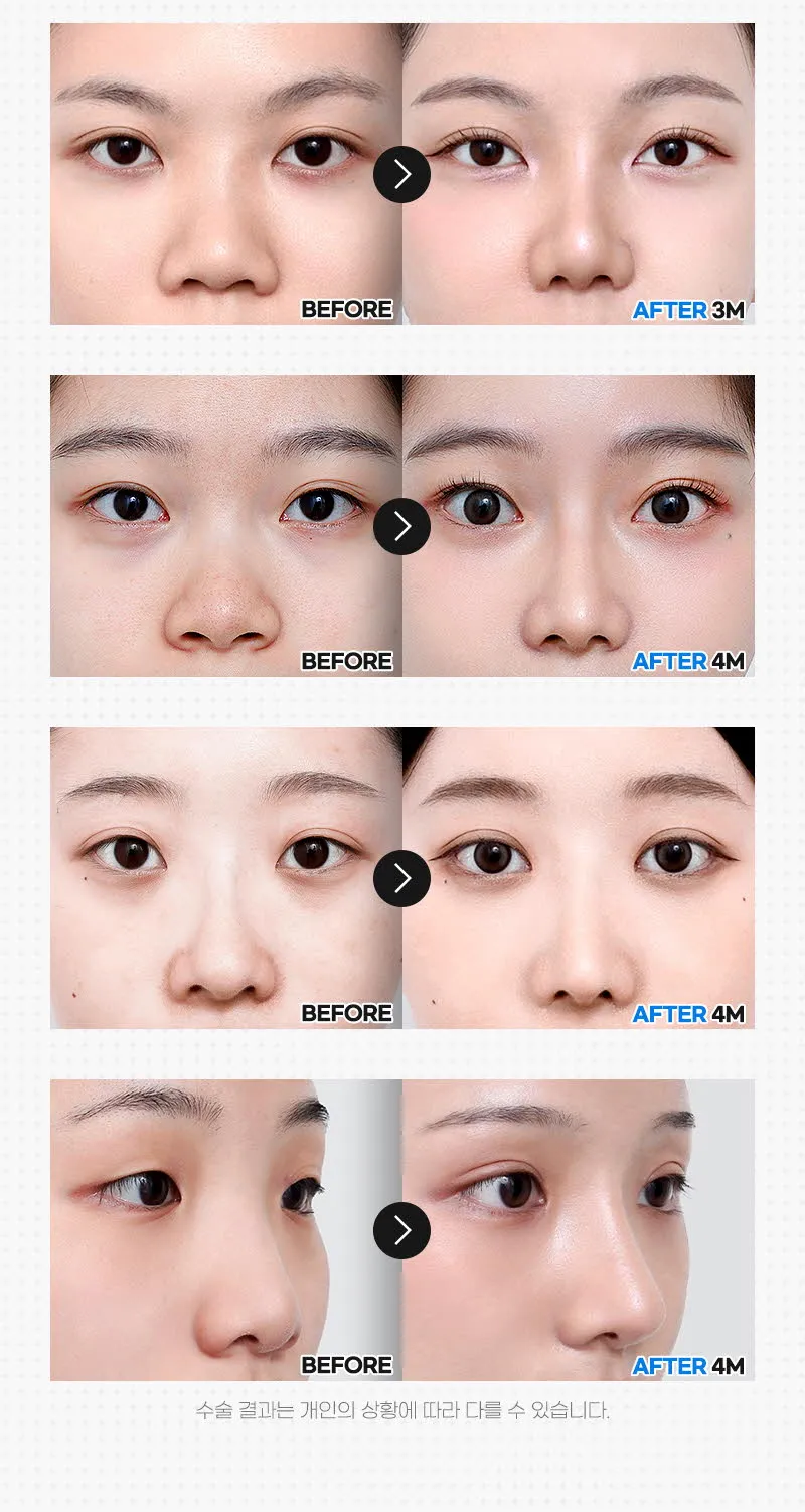 뷰성형외과 ❤️뷰❤️복코성형 이벤트, 시술 상세 이미지