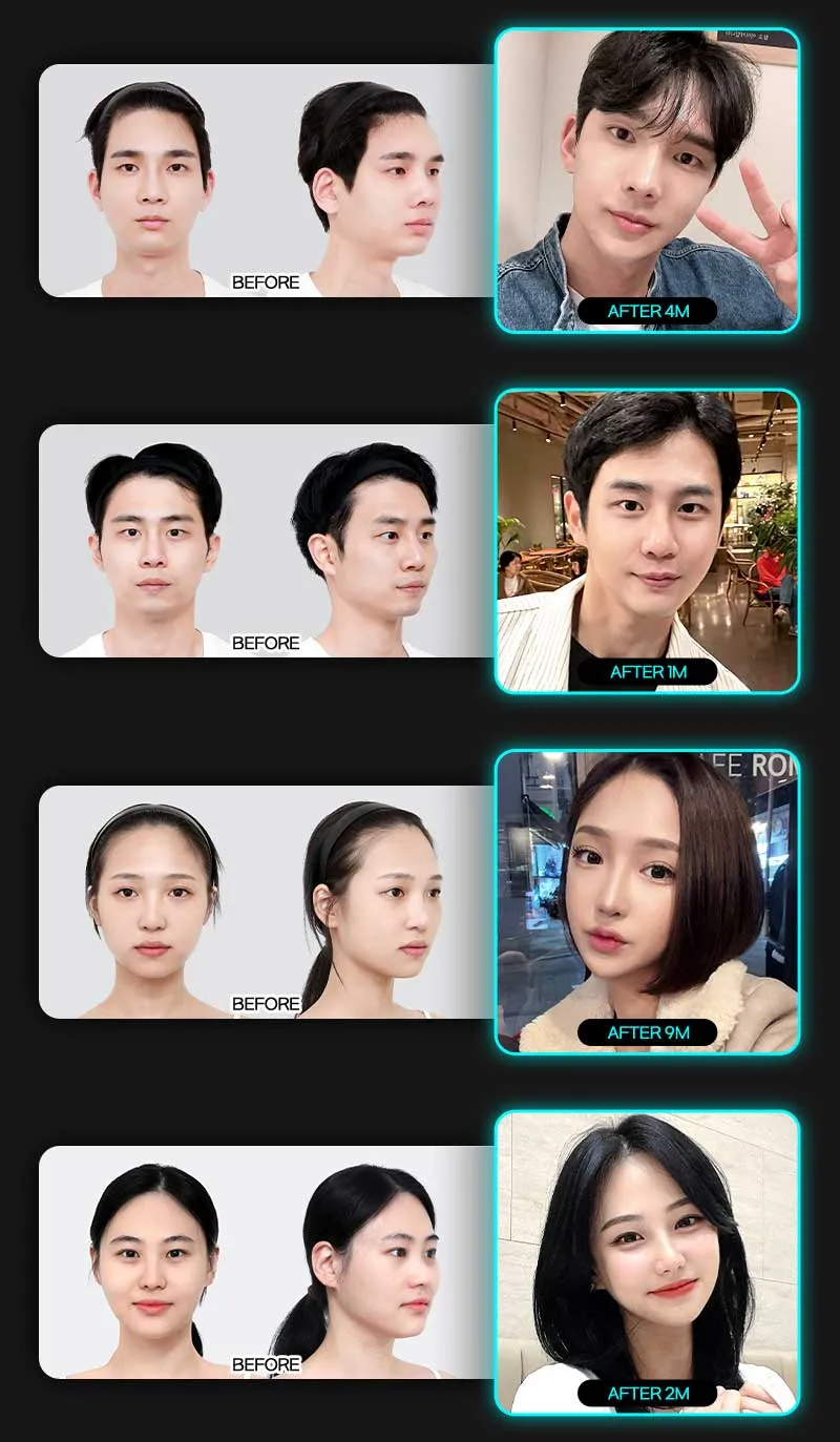 뷰성형외과 ❤️뷰❤️안면윤곽 이벤트, 시술 상세 이미지