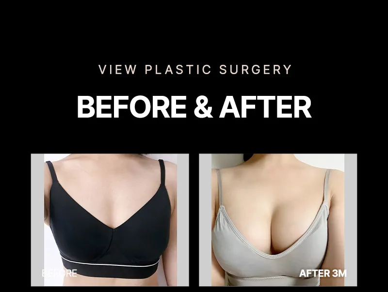 뷰성형외과 ❤뷰❤여의사 UIU 가슴성형 이벤트, 시술 상세 이미지