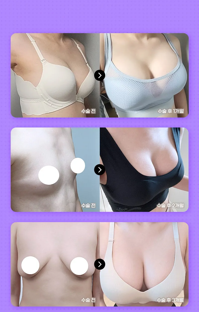 뷰성형외과 ❤뷰❤모티바 가슴 재수술 이벤트, 시술 상세 이미지