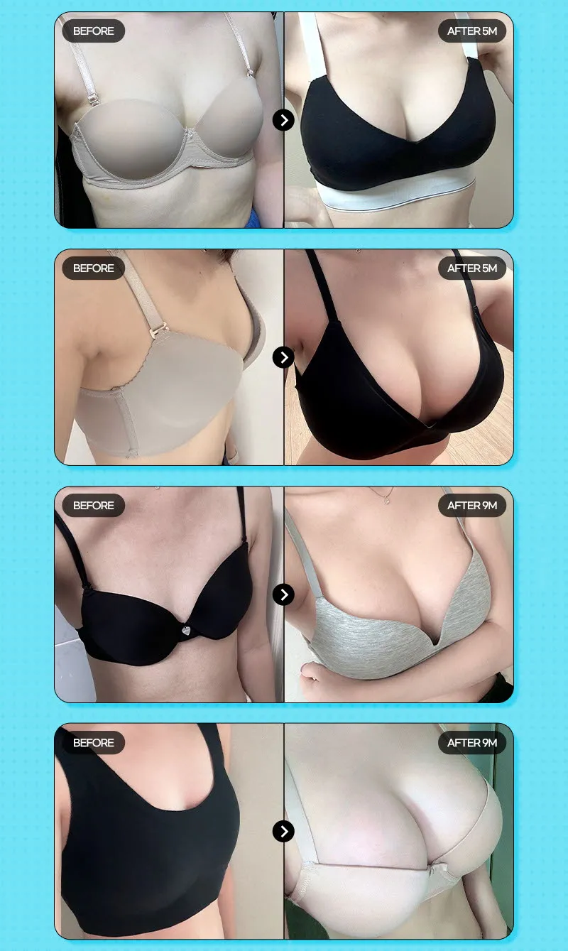 뷰성형외과 ❤️뷰❤️세빈 가슴성형 이벤트, 시술 상세 이미지