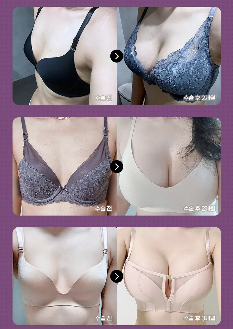 뷰성형외과 ❤️뷰❤️ 모티바 가슴성형 이벤트, 시술 상세 이미지